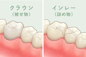 クラウン（被せ物）、インレー（詰め物）