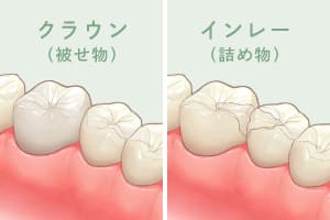 クラウン（被せ物）、インレー（詰め物）