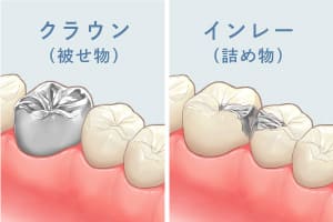 クラウン（被せ物）、インレー（詰め物）