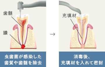 虫歯菌が感染した歯質や歯髄を除去→消毒後、充填剤を入れて密封