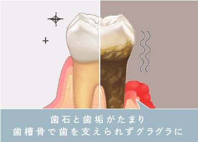 歯石と歯垢がたまり歯槽骨で歯を支えられずグラグラ