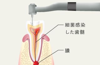 細菌感染した歯髄、膿