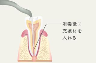 食毒後に充填剤を入れる