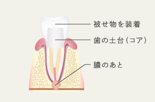 被せ物を装着、葉の土台、膿のあと